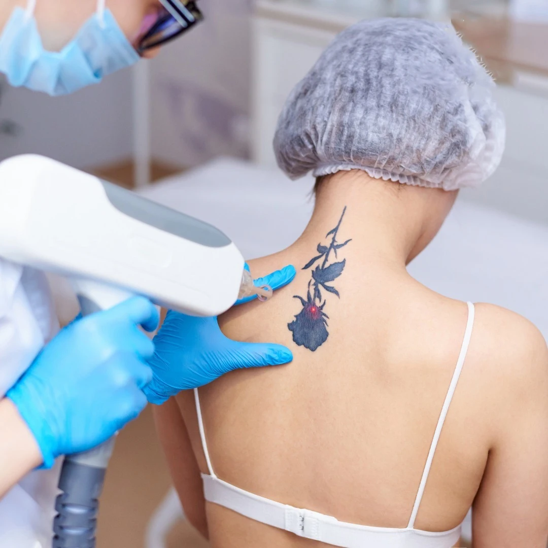 Laat uw tattoo removal in Almere professioneel en effectief uitvoeren voor snellere resultaten!